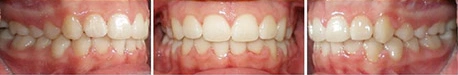 Close up front view of a patient's teeth after orthodontic treatment at Cranston Orthodontics