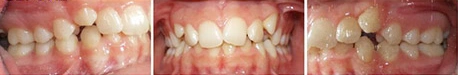 Close up front view of a patient's teeth before orthodontic treatment at Cranston Orthodontics