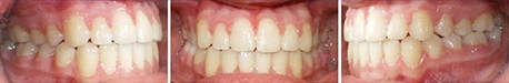 Close up front view of a patient's teeth after orthodontic treatment at Cranston Orthodontics