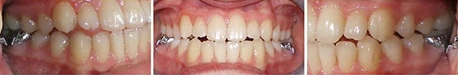 Close up front view of a patient's teeth before orthodontic treatment at Cranston Orthodontics