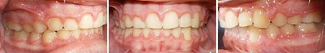 Close up front view of a patient's teeth after orthodontic treatment at Cranston Orthodontics