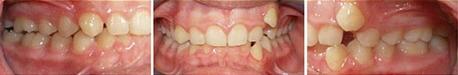 Close up front view of a patient's teeth before orthodontic treatment at Cranston Orthodontics
