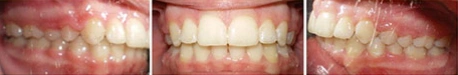 Close up front view of a patient's teeth after orthodontic treatment at Cranston Orthodontics