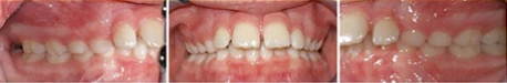 Close up front view of a patient's teeth after orthodontic treatment at Cranston Orthodontics
