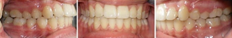 Close up front view of a patient's teeth after orthodontic treatment at Cranston Orthodontics