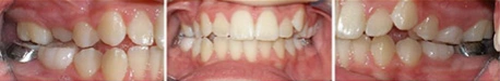 Close up front view of a patient's teeth before orthodontic treatment at Cranston Orthodontics