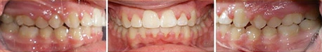 Close up front view of a patient's teeth after orthodontic treatment at Cranston Orthodontics