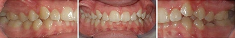 Close up front view of a patient's teeth before orthodontic treatment at Cranston Orthodontics