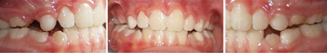 Close up front view of a patient's teeth after orthodontic treatment at Cranston Orthodontics
