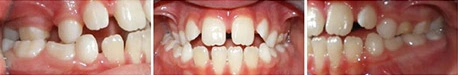 Close up front view of a patient's teeth before orthodontic treatment at Cranston Orthodontics