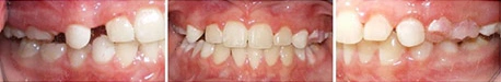 Close up front view of a patient's teeth after orthodontic treatment at Cranston Orthodontics