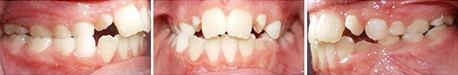 Close up front view of a patient's teeth before orthodontic treatment at Cranston Orthodontics