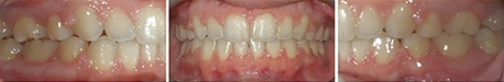 Close up front view of a patient's teeth after orthodontic treatment at Cranston Orthodontics