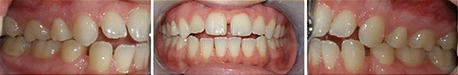 Close up front view of a patient's teeth before orthodontic treatment at Cranston Orthodontics