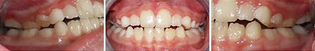 Close up front view of a patient's teeth after orthodontic treatment at Cranston Orthodontics