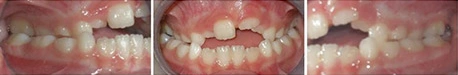 Close up front view of a patient's teeth before orthodontic treatment at Cranston Orthodontics