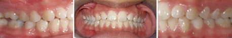 Close up front view of a patient's teeth after orthodontic treatment at Cranston Orthodontics
