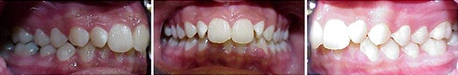 Close up front view of a patient's teeth before orthodontic treatment at Cranston Orthodontics