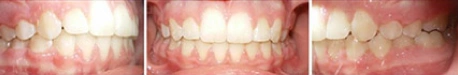 Close up front view of a patient's teeth after orthodontic treatment at Cranston Orthodontics