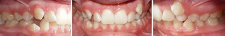 Close up front view of a patient's teeth before orthodontic treatment at Cranston Orthodontics