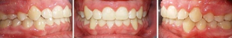 Close up front view of a patient's teeth after orthodontic treatment at Cranston Orthodontics