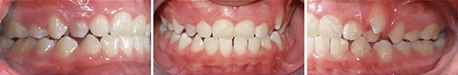 Close up front view of a patient's teeth before orthodontic treatment at Cranston Orthodontics