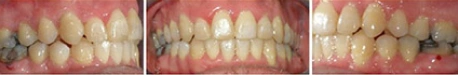 Close up front view of a patient's teeth after orthodontic treatment at Cranston Orthodontics