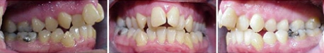 Close up front view of a patient's teeth before orthodontic treatment at Cranston Orthodontics
