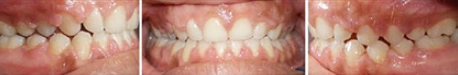 Close up front view of a patient's teeth after orthodontic treatment at Cranston Orthodontics