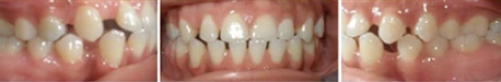 Close up front view of a patient's teeth before orthodontic treatment at Cranston Orthodontics