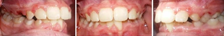 Close up front view of a patient's teeth after orthodontic treatment at Cranston Orthodontics