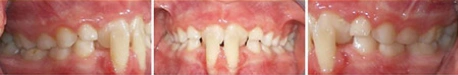Close up front view of a patient's teeth before orthodontic treatment at Cranston Orthodontics
