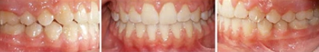 Close up front view of a patient's teeth after orthodontic treatment at Cranston Orthodontics