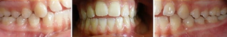 Close up front view of a patient's teeth before orthodontic treatment at Cranston Orthodontics