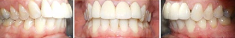 Close up front view of a patient's teeth after orthodontic treatment at Cranston Orthodontics