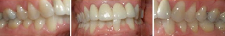 Close up front view of a patient's teeth before orthodontic treatment at Cranston Orthodontics
