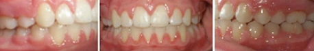Close up front view of a patient's teeth after orthodontic treatment at Cranston Orthodontics