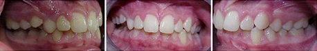 Close up front view of a patient's teeth before orthodontic treatment at Cranston Orthodontics