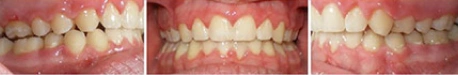 Close up front view of a patient's teeth after orthodontic treatment at Cranston Orthodontics