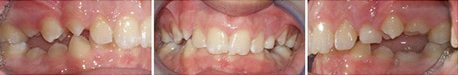 Close up front view of a patient's teeth before orthodontic treatment at Cranston Orthodontics