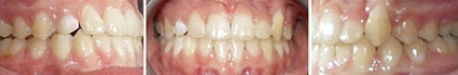 Close up front view of a patient's teeth after orthodontic treatment at Cranston Orthodontics