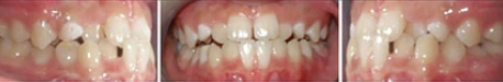 Close up front view of a patient's teeth before orthodontic treatment at Cranston Orthodontics