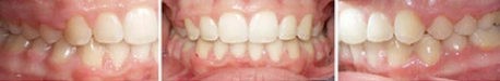 Close up front view of a patient's teeth after orthodontic treatment at Cranston Orthodontics