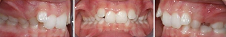 Close up front view of a patient's teeth before orthodontic treatment at Cranston Orthodontics