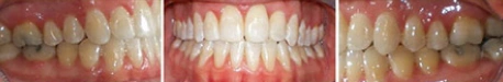 Close up front view of a patient's teeth after orthodontic treatment at Cranston Orthodontics