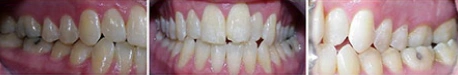 Close up front view of a patient's teeth before orthodontic treatment at Cranston Orthodontics