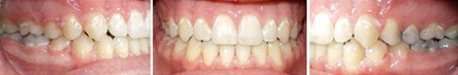 Close up front view of a patient's teeth after orthodontic treatment at Cranston Orthodontics