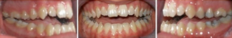 Close up front view of a patient's teeth before orthodontic treatment at Cranston Orthodontics
