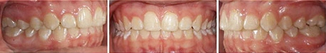 Close up front view of a patient's teeth after orthodontic treatment at Cranston Orthodontics