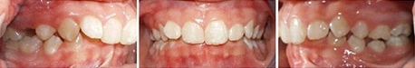 Close up front view of a patient's teeth before orthodontic treatment at Cranston Orthodontics